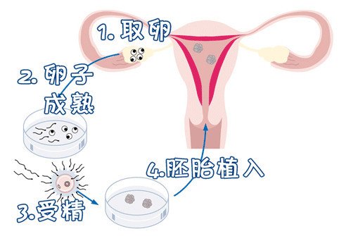 无精症成功案例